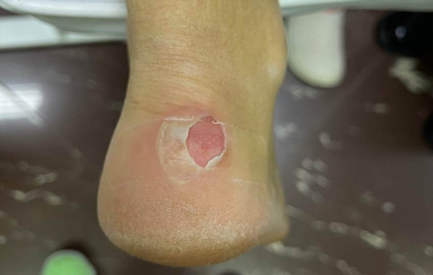 Як позбутися водянки на нозі без болю та ускладнень